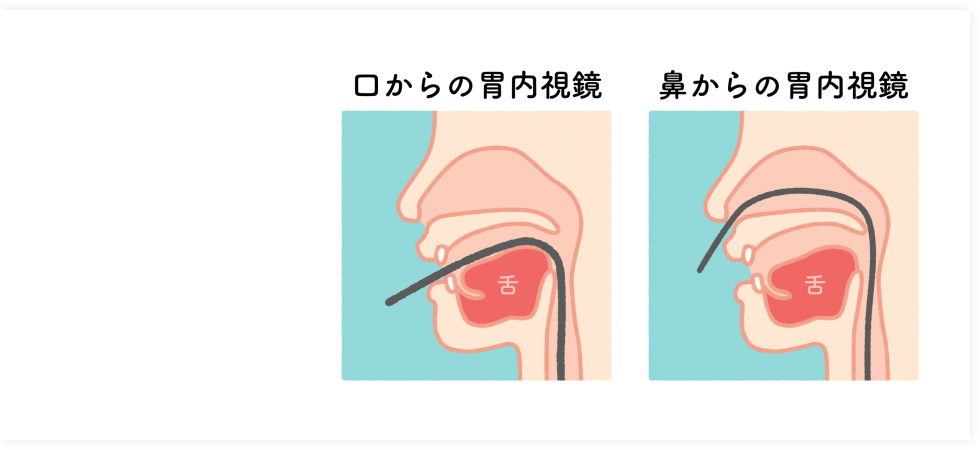 口からの内視鏡に不安のある方も安心鼻からの内視鏡検査にも対応