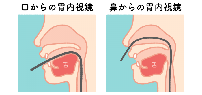 口からの内視鏡に不安のある方も安心鼻からの内視鏡検査にも対応